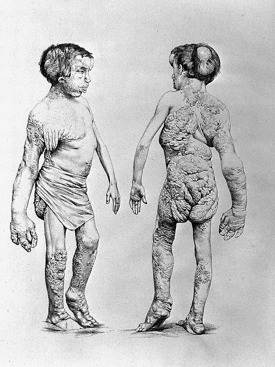 Fotografía histórica del verdadero Joseph Merrick, El Hombre Elefante